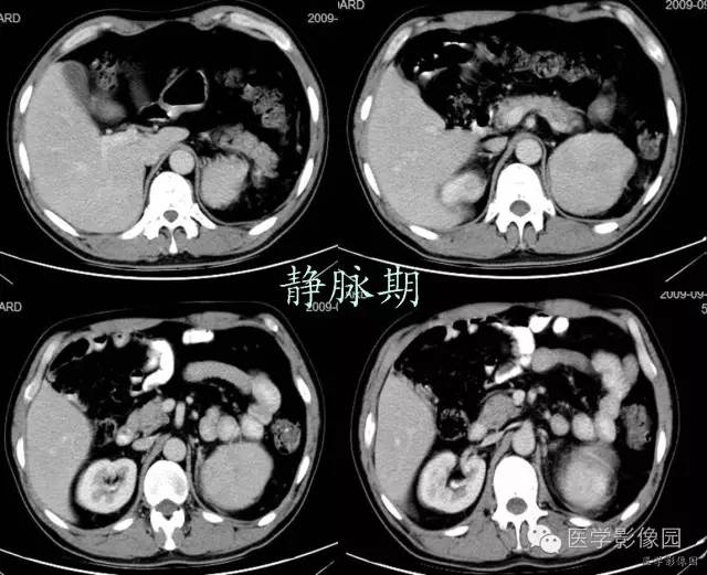 【病例】腹膜后副脾1例CT影像表现
