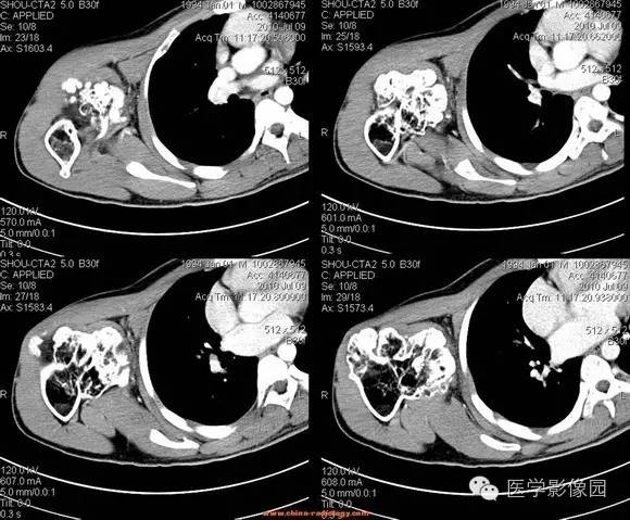 【病例】右肱骨上段骨软骨瘤1例CT影像表现 【病例】右肱骨上段骨软骨瘤1例CT影像表现