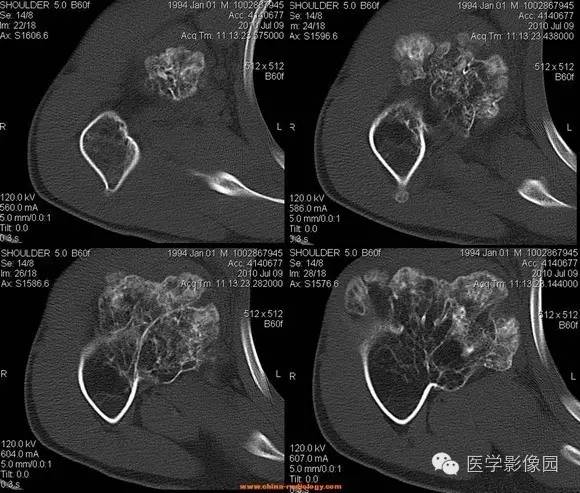 【病例】右肱骨上段骨软骨瘤1例CT影像表现 【病例】右肱骨上段骨软骨瘤1例CT影像表现