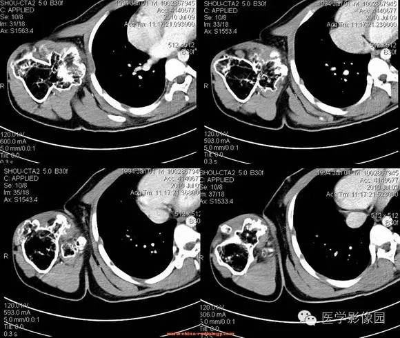 【病例】右肱骨上段骨软骨瘤1例CT影像表现 【病例】右肱骨上段骨软骨瘤1例CT影像表现