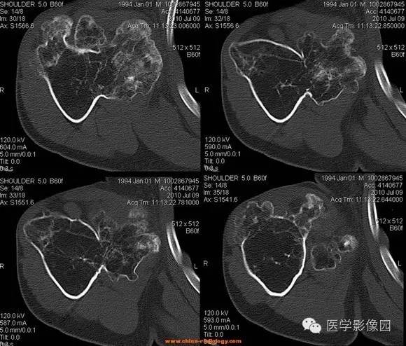 【病例】右肱骨上段骨软骨瘤1例CT影像表现 【病例】右肱骨上段骨软骨瘤1例CT影像表现