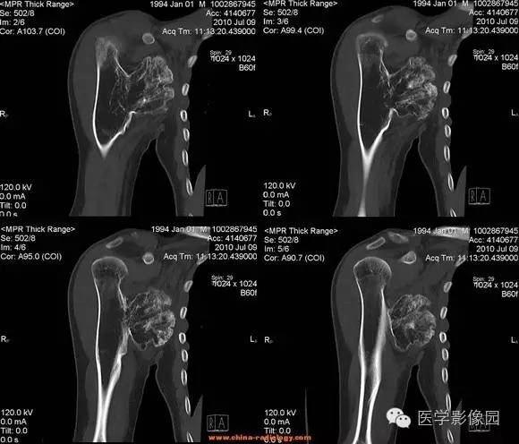 【病例】右肱骨上段骨软骨瘤1例CT影像表现 【病例】右肱骨上段骨软骨瘤1例CT影像表现