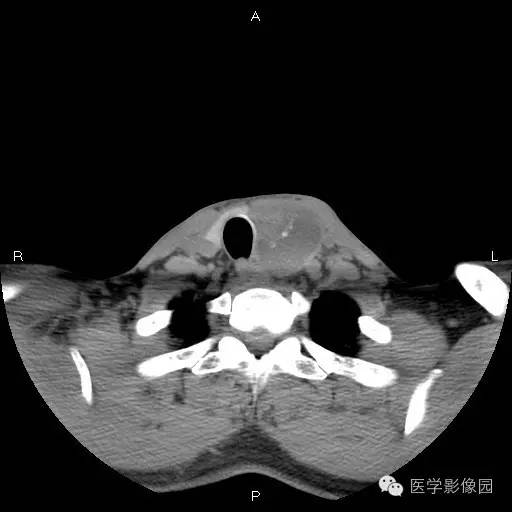 【病例】左侧甲状腺乳头状癌1例CT影像表现 【病例】左侧甲状腺乳头状癌1例CT影像表现