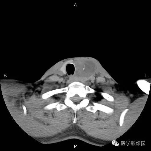 【病例】左侧甲状腺乳头状癌1例CT影像表现 【病例】左侧甲状腺乳头状癌1例CT影像表现