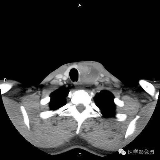 【病例】左侧甲状腺乳头状癌1例CT影像表现 【病例】左侧甲状腺乳头状癌1例CT影像表现