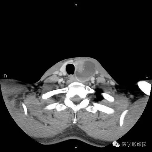 【病例】左侧甲状腺乳头状癌1例CT影像表现 【病例】左侧甲状腺乳头状癌1例CT影像表现