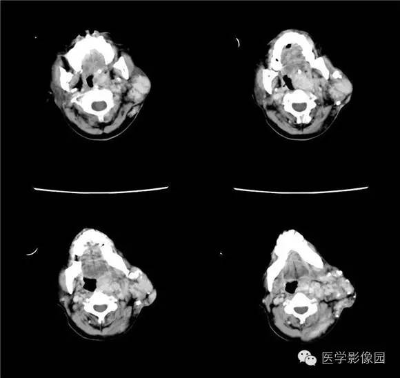 【病例】颈部蔓状血管瘤1例CT影像表现 【病例】颈部蔓状血管瘤1例CT影像表现