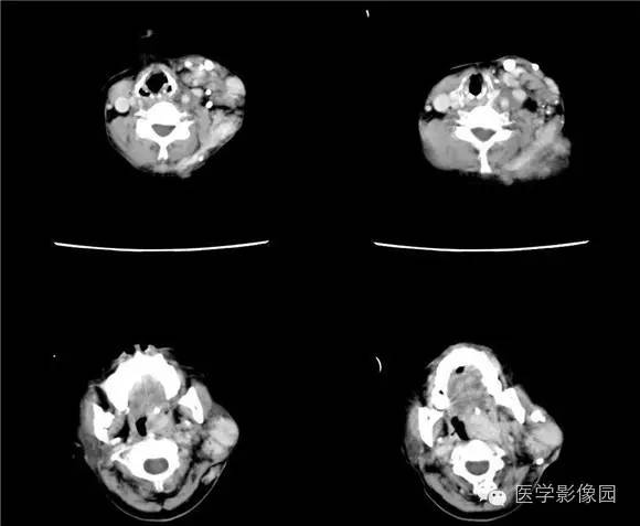 【病例】颈部蔓状血管瘤1例CT影像表现 【病例】颈部蔓状血管瘤1例CT影像表现