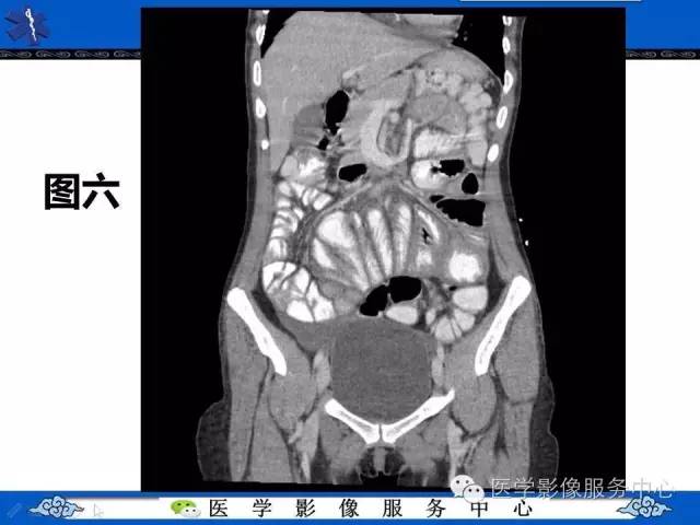 【PPT】腹茧症