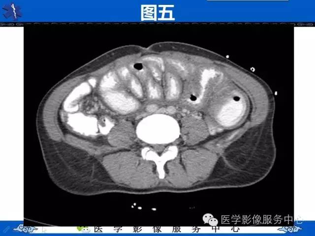 【PPT】腹茧症