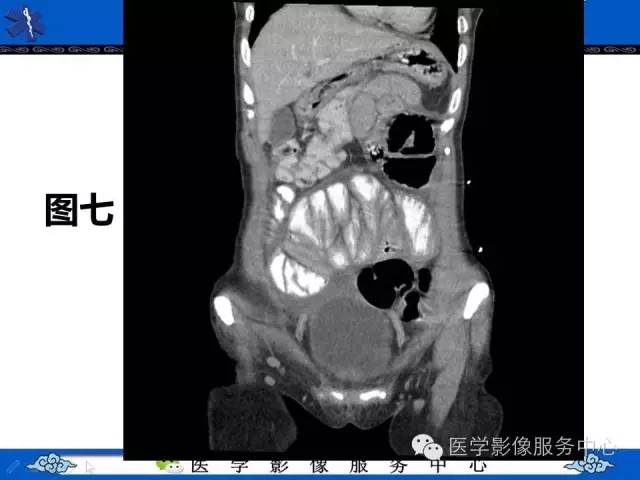 【PPT】腹茧症