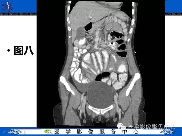 【PPT】腹茧症
