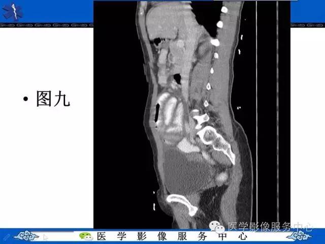 【PPT】腹茧症