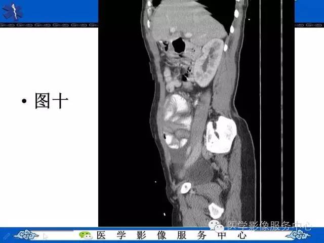 【PPT】腹茧症
