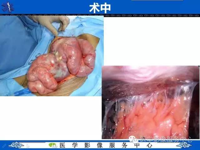 【PPT】腹茧症