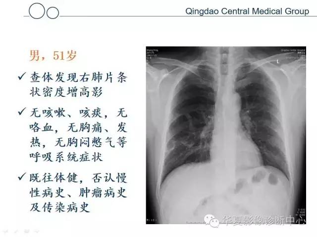 【病例】肺隐球菌感染1例CT影像表现
