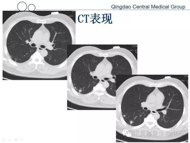【病例】肺隐球菌感染1例CT影像表现