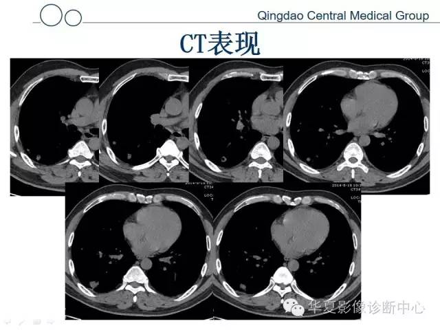 【病例】肺隐球菌感染1例CT影像表现