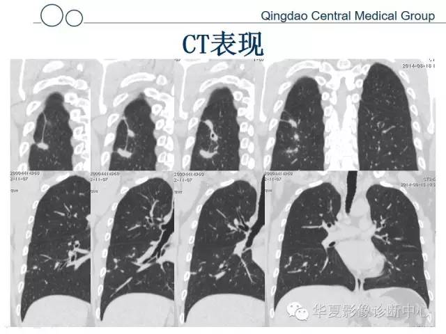 【病例】肺隐球菌感染1例CT影像表现