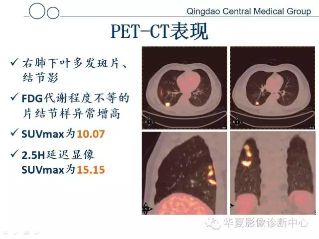 【病例】肺隐球菌感染1例CT影像表现