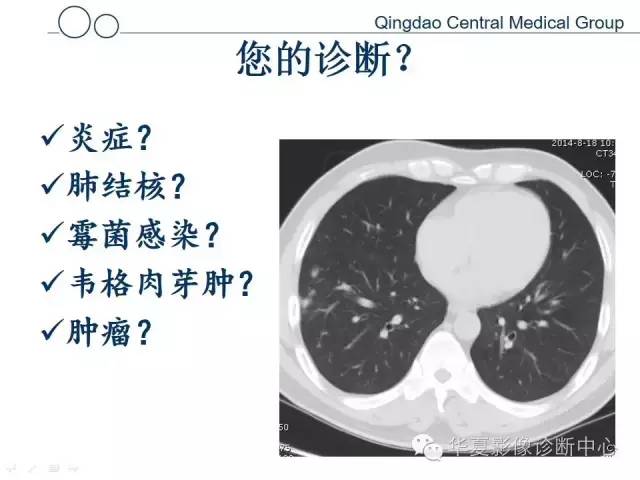 【病例】肺隐球菌感染1例CT影像表现