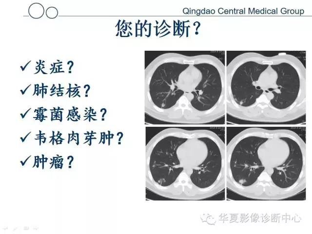 【病例】肺隐球菌感染1例CT影像表现