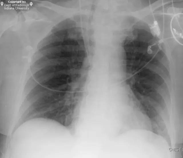 【病例】甲状腺肿1例CT影像表现