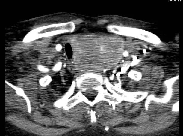 【病例】甲状腺肿1例CT影像表现 【病例】甲状腺肿1例CT影像表现