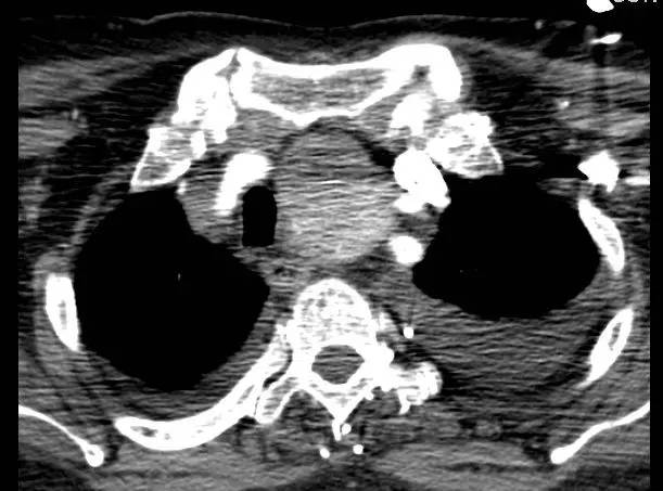 【病例】甲状腺肿1例CT影像表现 【病例】甲状腺肿1例CT影像表现
