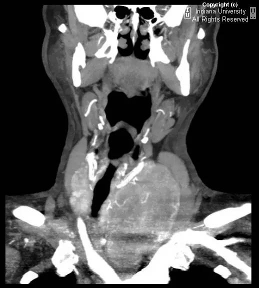 【病例】甲状腺肿1例CT影像表现 【病例】甲状腺肿1例CT影像表现