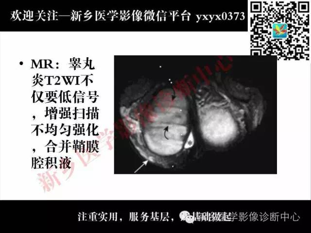 【PPT】阴囊病变影像诊断