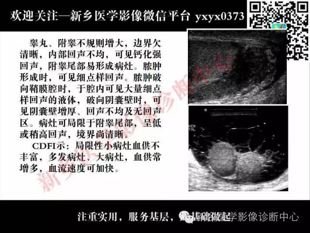 【PPT】阴囊病变影像诊断
