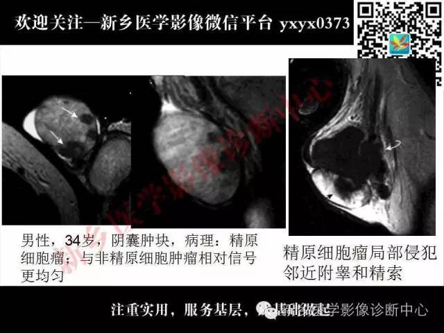 【PPT】阴囊病变影像诊断
