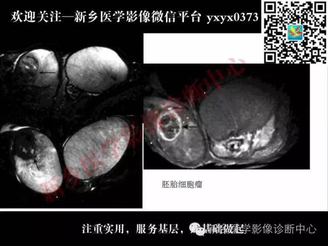 【PPT】阴囊病变影像诊断
