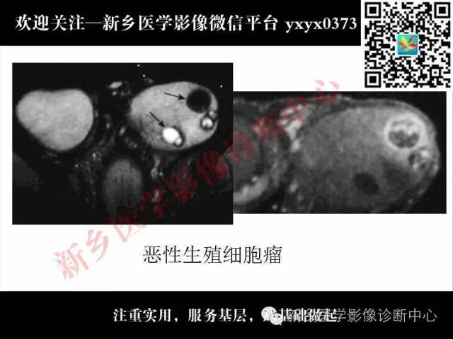 【PPT】阴囊病变影像诊断
