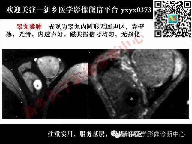 【PPT】阴囊病变影像诊断