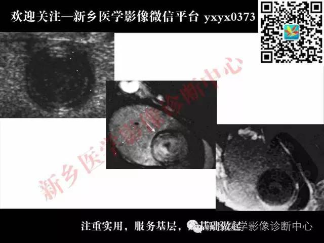【PPT】阴囊病变影像诊断