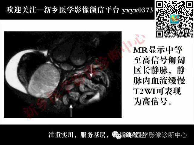 【PPT】阴囊病变影像诊断
