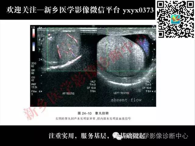【PPT】阴囊病变影像诊断