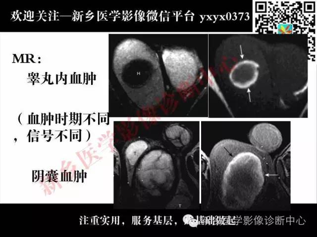 【PPT】阴囊病变影像诊断