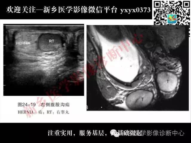 【PPT】阴囊病变影像诊断