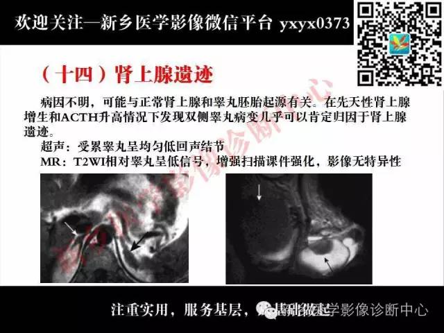【PPT】阴囊病变影像诊断