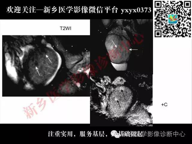 【PPT】阴囊病变影像诊断