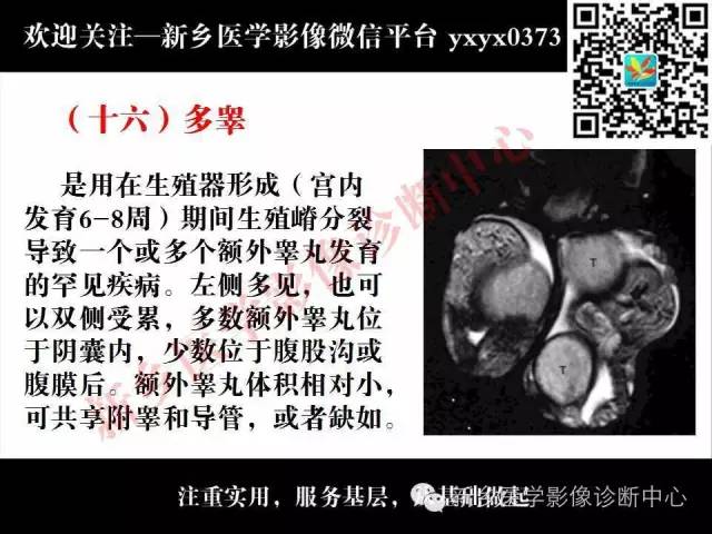 【PPT】阴囊病变影像诊断