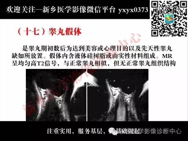 【PPT】阴囊病变影像诊断