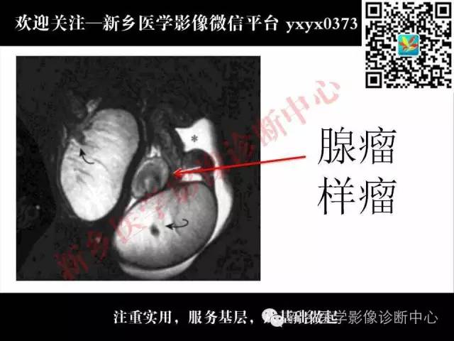 【PPT】阴囊病变影像诊断