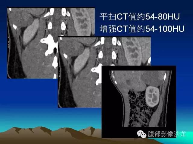 【病例】腹膜后囊性畸胎瘤1例影像诊断与鉴别诊断