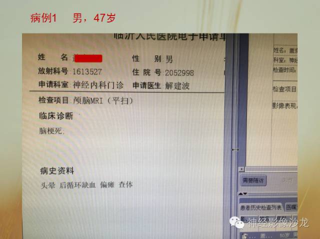 【病例】多灶性胶质瘤1例CT及MR影像表现
