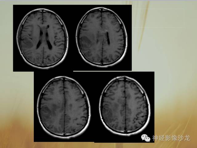 【病例】多灶性胶质瘤1例CT及MR影像表现