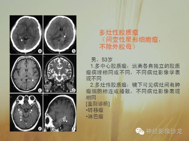 【病例】多灶性胶质瘤1例CT及MR影像表现